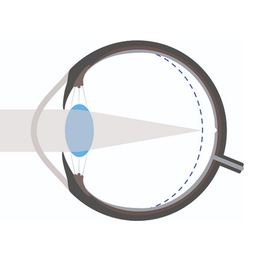 Myopia Control – IHOLICS Optician & Optometrist